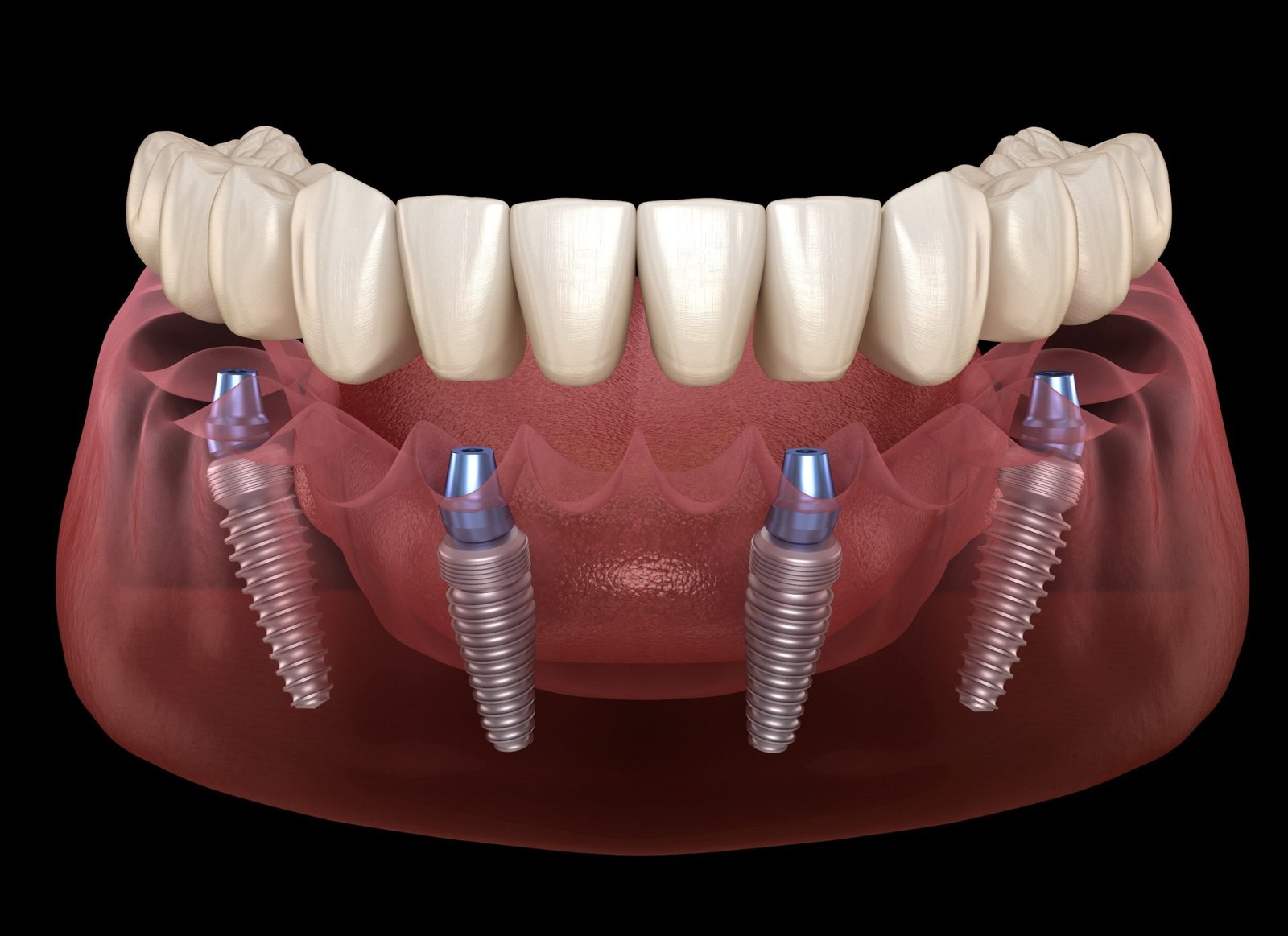 All-On-4 dental implants service