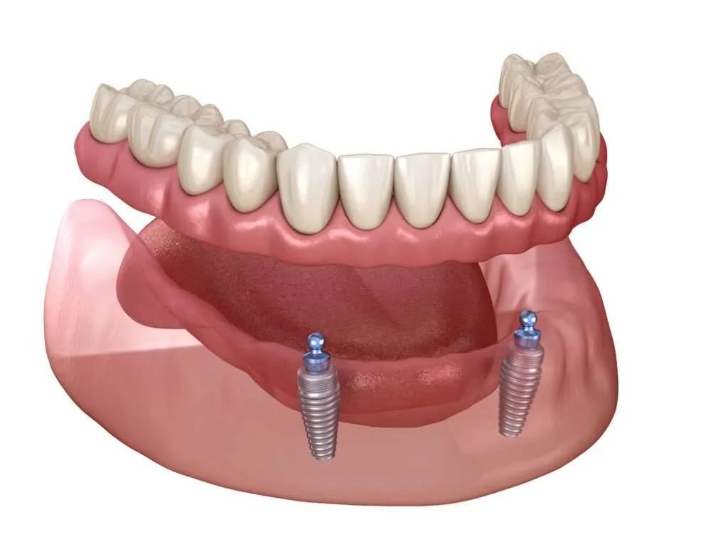 Implant supported dentures service