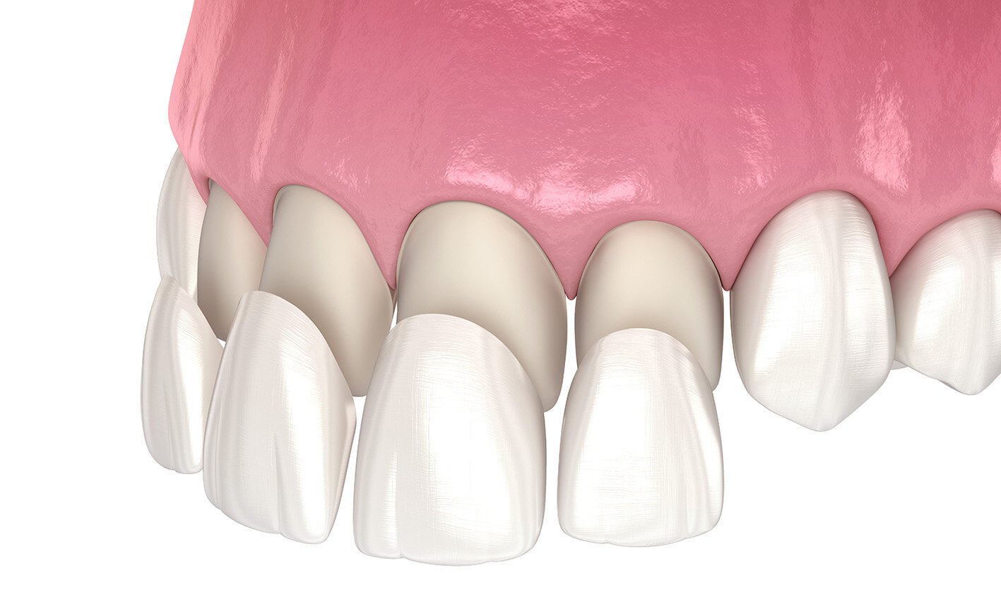 Porcelain veneers cosmetic dentistry