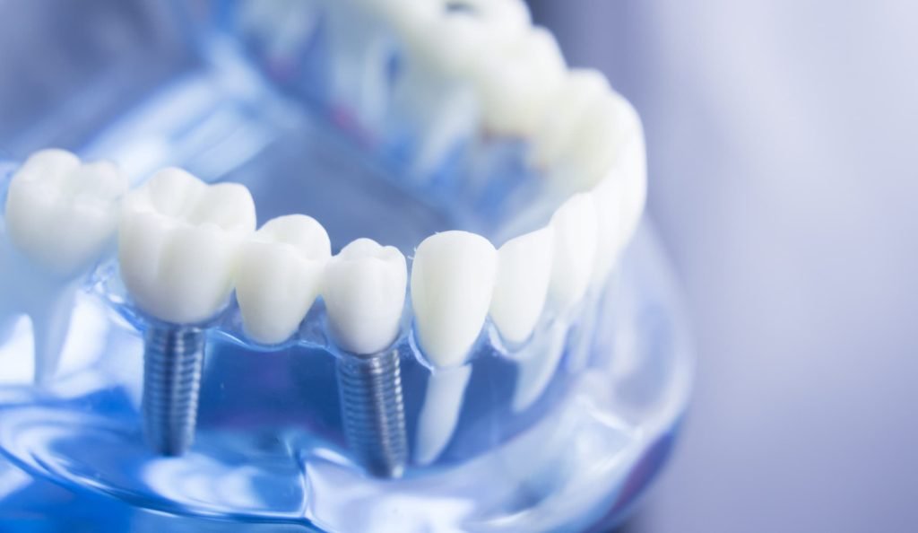 Same day implants dental service