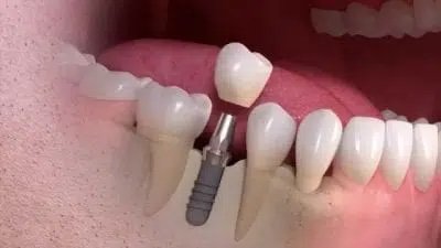 Single implant dental service