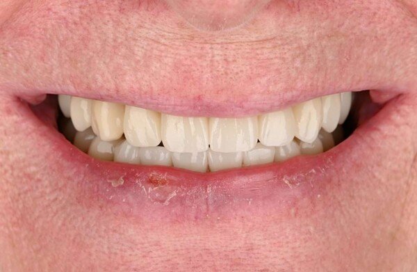 After dental implant treatment