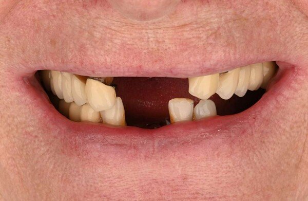 Before dental implant treatment
