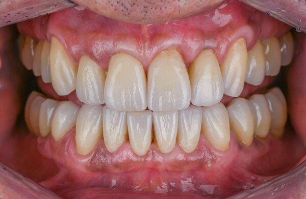 After dental implant treatment