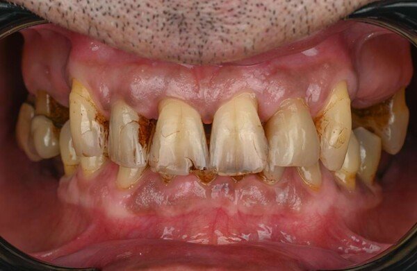 Before dental implant treatment