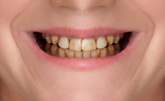 Before dental implant treatment