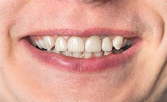After dental implant treatment