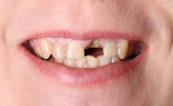 Before dental implant treatment
